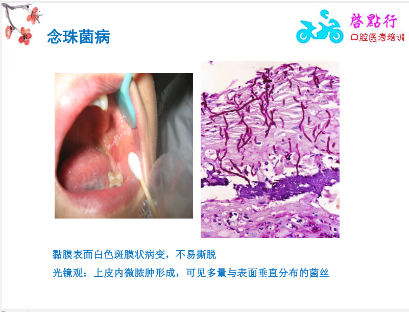 启点行 2019年 口腔黏膜病 第一部分